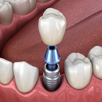 Animation of implant tooth replacement process