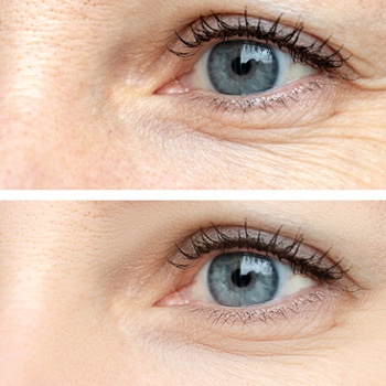 a before-and-after image of the effects of BOTOX around someone’s eyes
