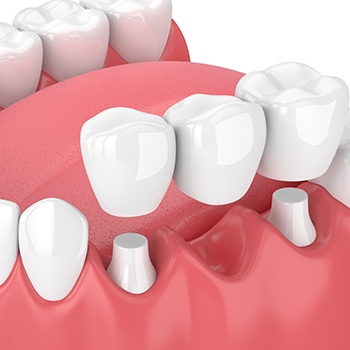 An illustration of a traditional dental bridge anchored to natural teeth