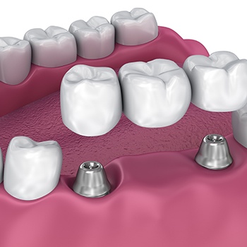 An illustration of an implant-supported dental bridge in the jawbone