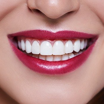 Closeup of smile after gum recontouring