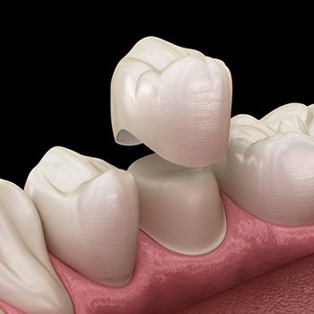 Exploded illustration of dental crown with tooth
