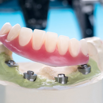 Model showing dental implants supporting full denture
