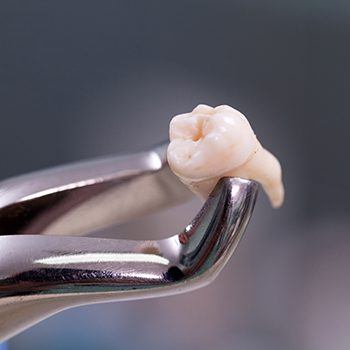 Metal clasp holding extracted tooth