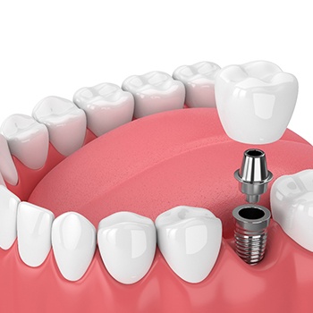3D illustration of dental implant, abutment, and crown