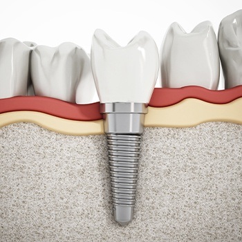 Animation of implant supported dental crown