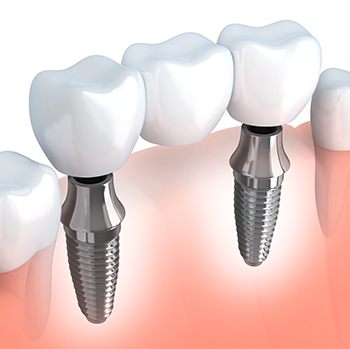 Animation of implant supported fixed bridge