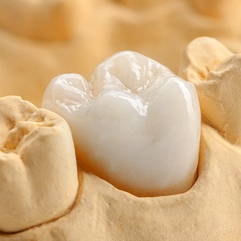 Model smile with custom dental crown
