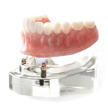 Model implant retained denture