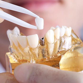 Model implant supported dental crown