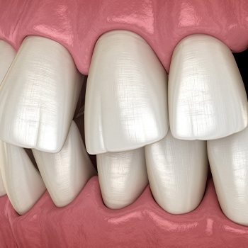 Animated teeth crowded together before Invisalign