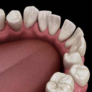 Animated teeth spaced too far apart before Invisalign