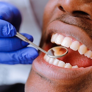 Healthy smile after tooth-colored filling placement