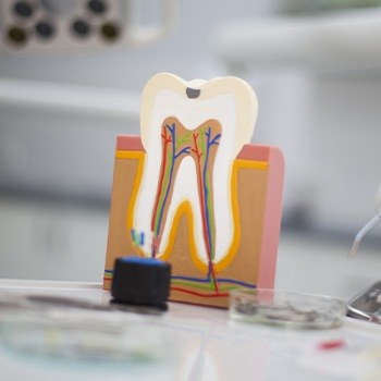 Model of the inside of a tooth before root canal therapy