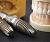 Dental implants and model smile