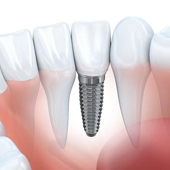 A diagram of a single tooth dental implant in Chesterton.