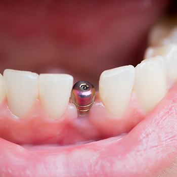 A mouth with an uncovered implant post.