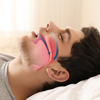 Sleeping man with airway animation before sleep apnea treatment