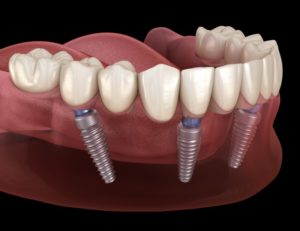 All-on-4 dental implants in Chesterton on bottom arch 