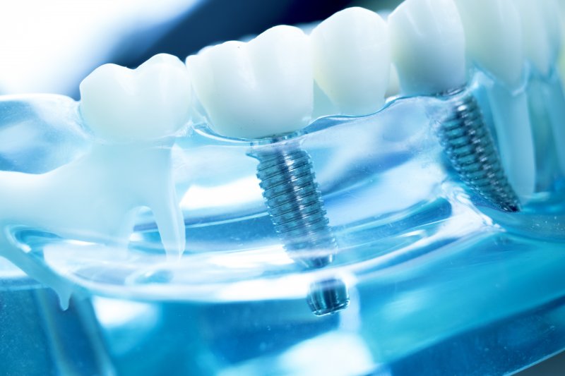 Dental implants