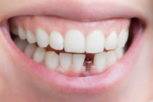Person smiling to reveal their dental implant post