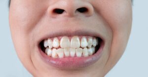 Close-up of person’s smile showing teeth out of alignment.